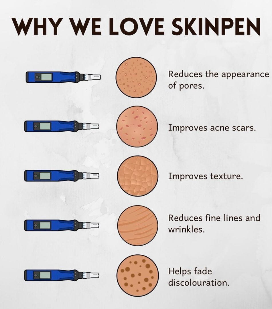 Instagram post by Dr. Ryan J. Matherne: Why do we love SkinPen? ✨ Because great skin starts from within!💙 SkinPen microneedling can help improve the appearance of pores, acne scar…