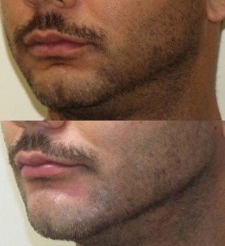 Instagram post by Dr. S. Kent Brown: 💪🔥 HArmonyCA® Filler for Men — Sculpted, Strong, Defined Not all fillers are created equal — and not all are designed with men’s facial st…