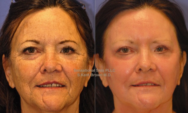 Instagram post by Dr. S. Kent Brown: 🔥 One Procedure. Stunning Results. ✨ Dr. Brown’s MaxFX CO₂ Laser — Now at Sensational Skin Scottsdale! ✨ Ready for dramatic skin rejuvenati…