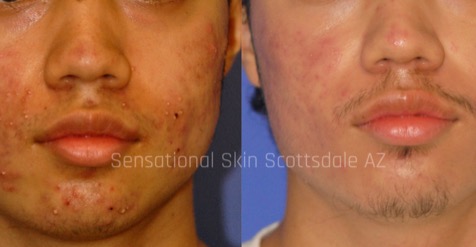 Instagram post by Dr. S. Kent Brown: ✨ Clear Your Skin. Restore Your Confidence. Acne & Acne Scar Treatments — Scottsdale, AZ Breakouts don’t just affect teens — acne can follow…