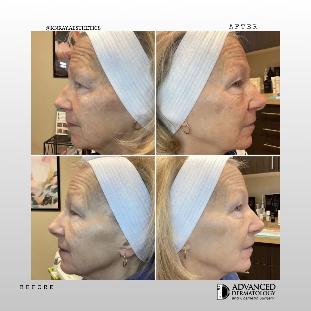 Instagram post by Dr. Saad Alsubaie: Venus IPL + Venus Viva! 💫 Designed to improve the appearance of uneven skin tone, texture, redness, and signs of sun damage—revealing a smo…
