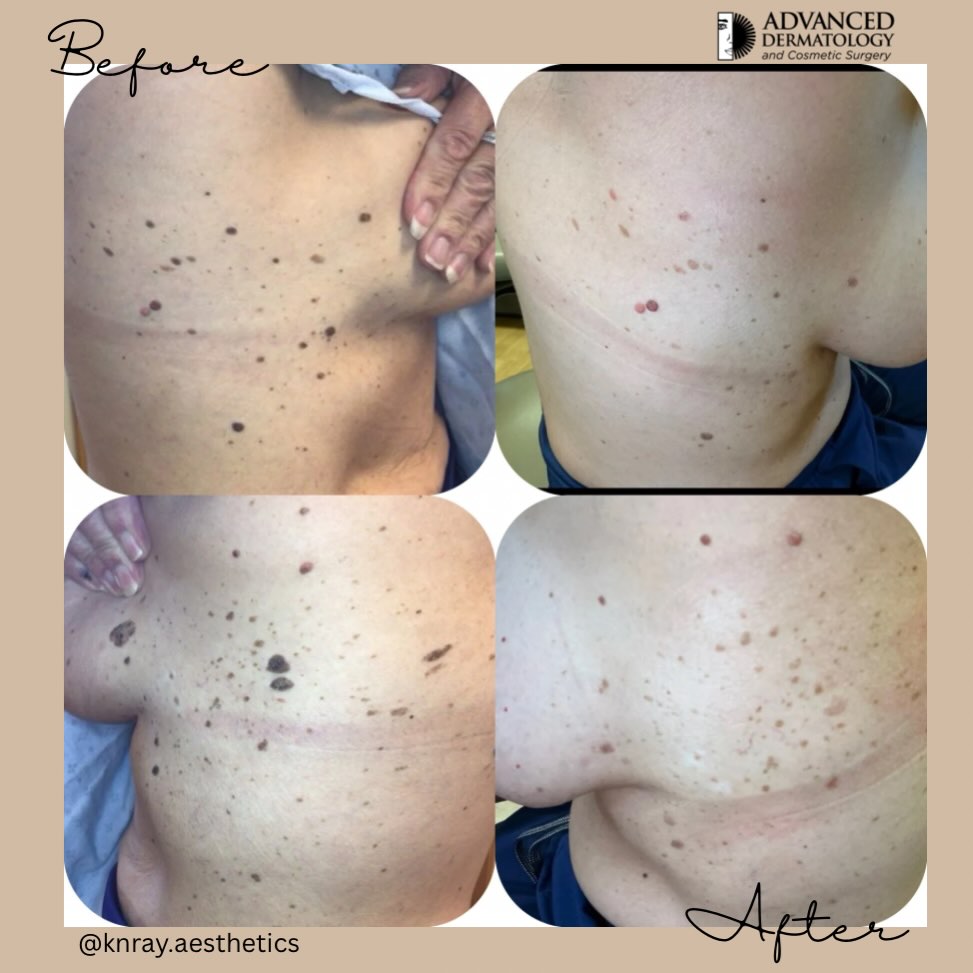 Instagram post by Dr. Saad Alsubaie: ✨ Bye-bye, texture! 👋 Hello, smoother-looking skin! Our VI Body Peel helps refresh the look of skin affected by seborrheic keratoses, uneve…