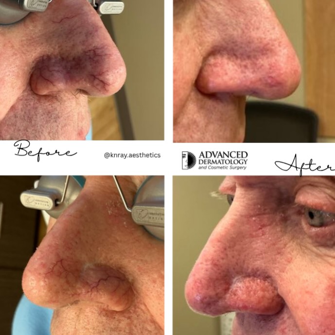 Instagram post by Dr. Saad Alsubaie: ✨ Nose Vein Removal | Before & After ✨ A subtle treatment with a beautiful difference! GentleMax Pro® helps target visible vessels on the no…