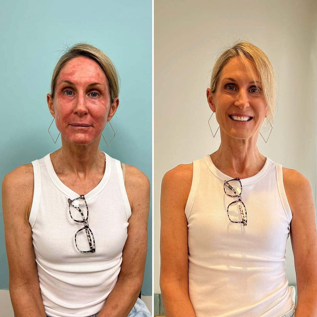 Instagram post by Dr. Saba Ghorab: ✨Transformation Tuesday✨ This lovely patient had a deep chemical peel 2 weeks ago. She has fully peeled, with beautiful new skin that is mor…