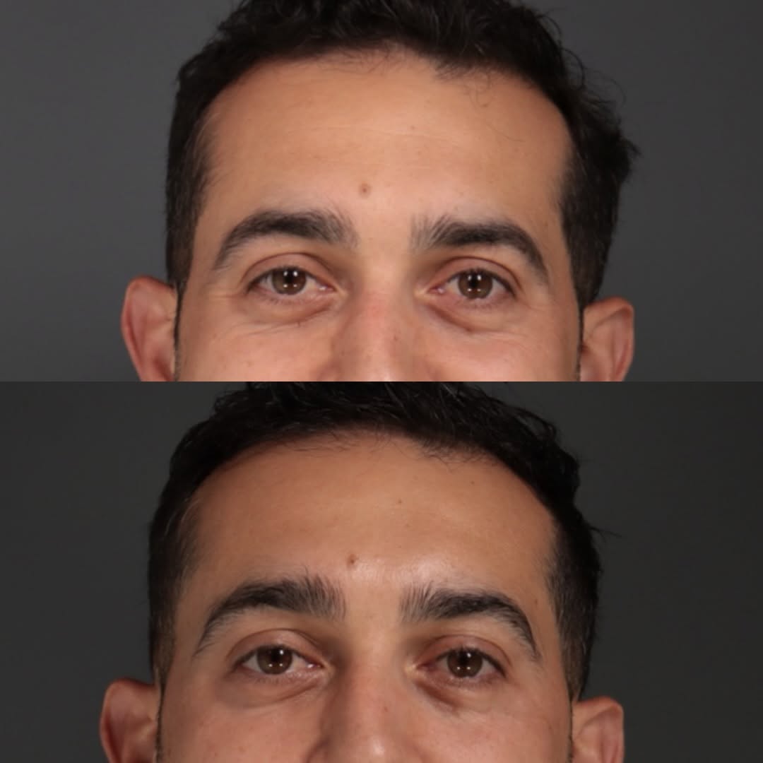 Instagram post by Dr. Sachin S. Parikh: Brotox update. Subtle, refreshed, still him. ✨ His main concern was the wrinkles around his eyes, specifically his crow’s feet. We softened …
