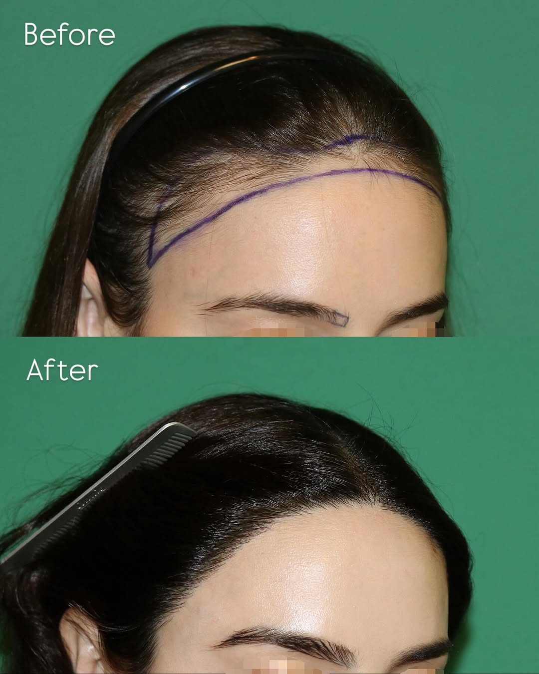 Instagram post by Dr. Sahar Nadimi: Before and after #hairline and #eyebrow reshaping. This beautiful patient wanted a thicker and more feminine hairline. She also wished to th…