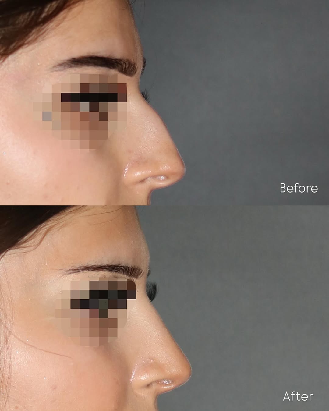 Instagram post by Dr. Sahar Nadimi: Before & after #rhinoplasty and #septoplasty surgery to reduce a dorsal hump and improve nasal breathing. She is 3 months postop and we are …