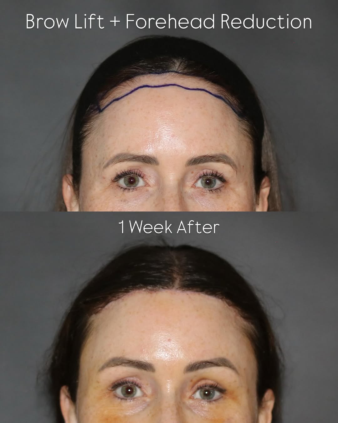 Instagram post by Dr. Sahar Nadimi: Before & 1 week after a combined Brow Lift and Forehead Reduction Surgery. These procedures can be safely and effectively done together thro…