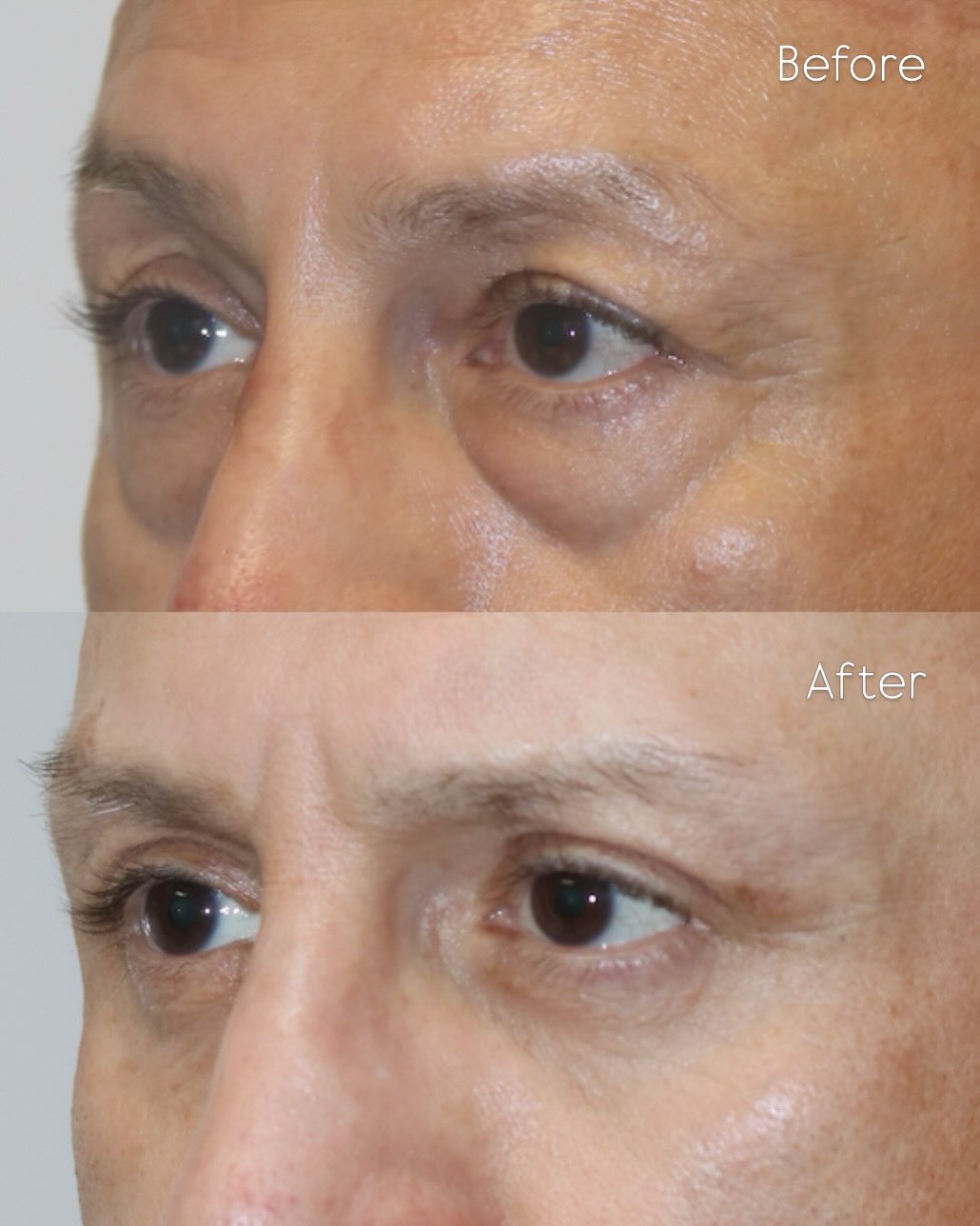 Instagram post by Dr. Sahar Nadimi: Before & after: upper + lower blepharoplasty with fat grafting The goal was a refreshed, well-rested appearance while preserving strong male…
