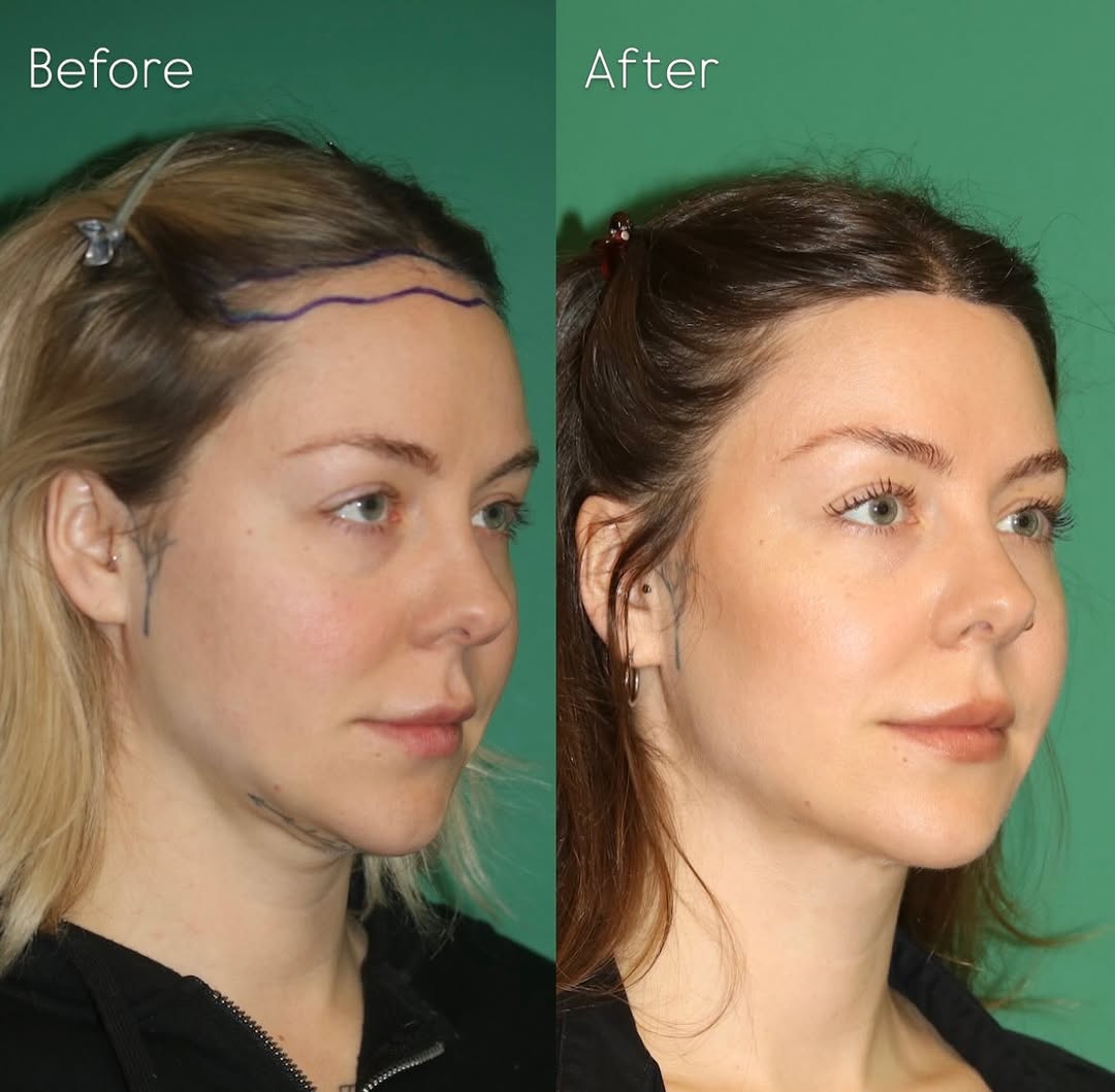 Instagram post by Dr. Sahar Nadimi: Before and 18 months after Brow Lift & Forehead Reduction Surgery. Through a single hairline incision, these procedures can be safely and ef…