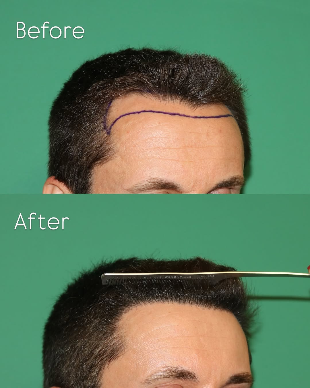 Instagram post by Dr. Sahar Nadimi: Before & 1 year after FUE hairline restoration. A total of 2,050 grafts were used to create a natural, age-appropriate hairline. We’re thril…