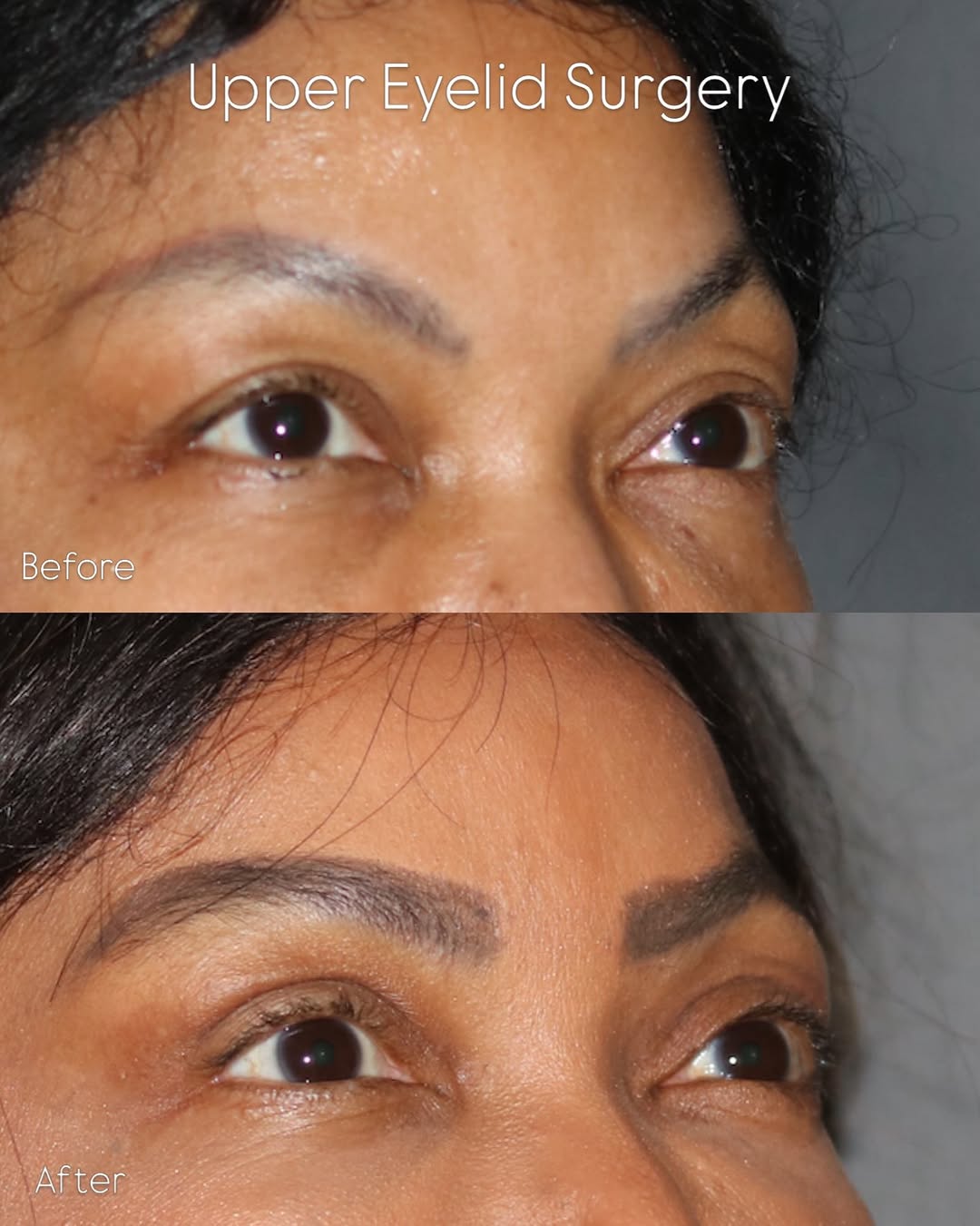 Instagram post by Dr. Sahar Nadimi: Before & after Upper Eyelid Surgery #blepharoplasty performed in the office under local anesthesia. A subtle refresh with minimal downtime a…
