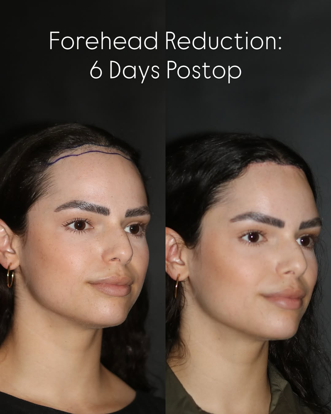 Instagram post by Dr. Sahar Nadimi: Before & 6 days after Forehead Reduction/ Hairline Lowering Surgery Often times, the most subtle change creates the greatest impact. Forehea…
