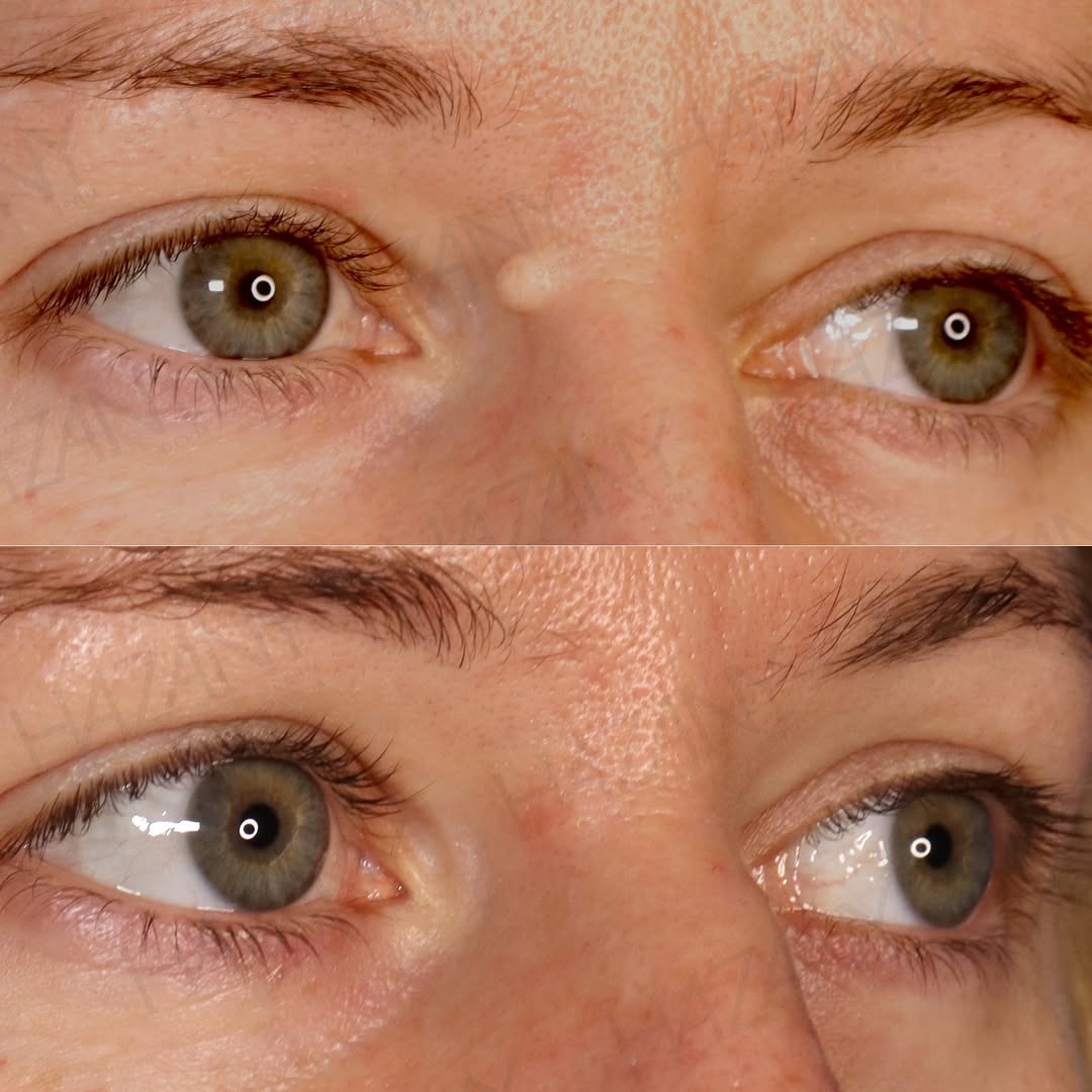 Instagram post by Dr. Salar Hazany: Mole reduction is a procedure that we perform when a client wants to make their mole less noticeable without erasing it completely. This cas…