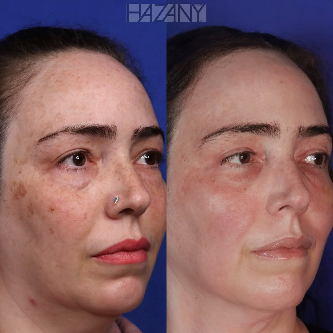 Instagram post by Dr. Salar Hazany: Five year before and after Erbium YAG Laser Resurfacing (NOT CO2) Downtime: 5 days Laser resurfacing done by an expert can have long lasting…