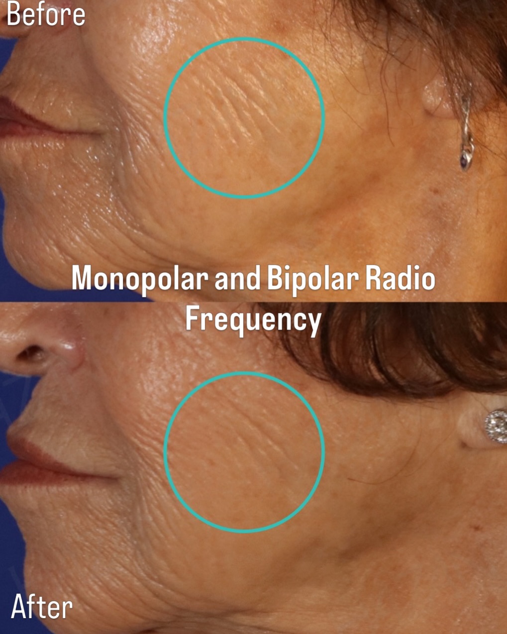 Instagram post by Dr. Salar Hazany: We have the best radio frequency skin tightening device andprotocol available. In the below before and after comparison you can see the decr…
