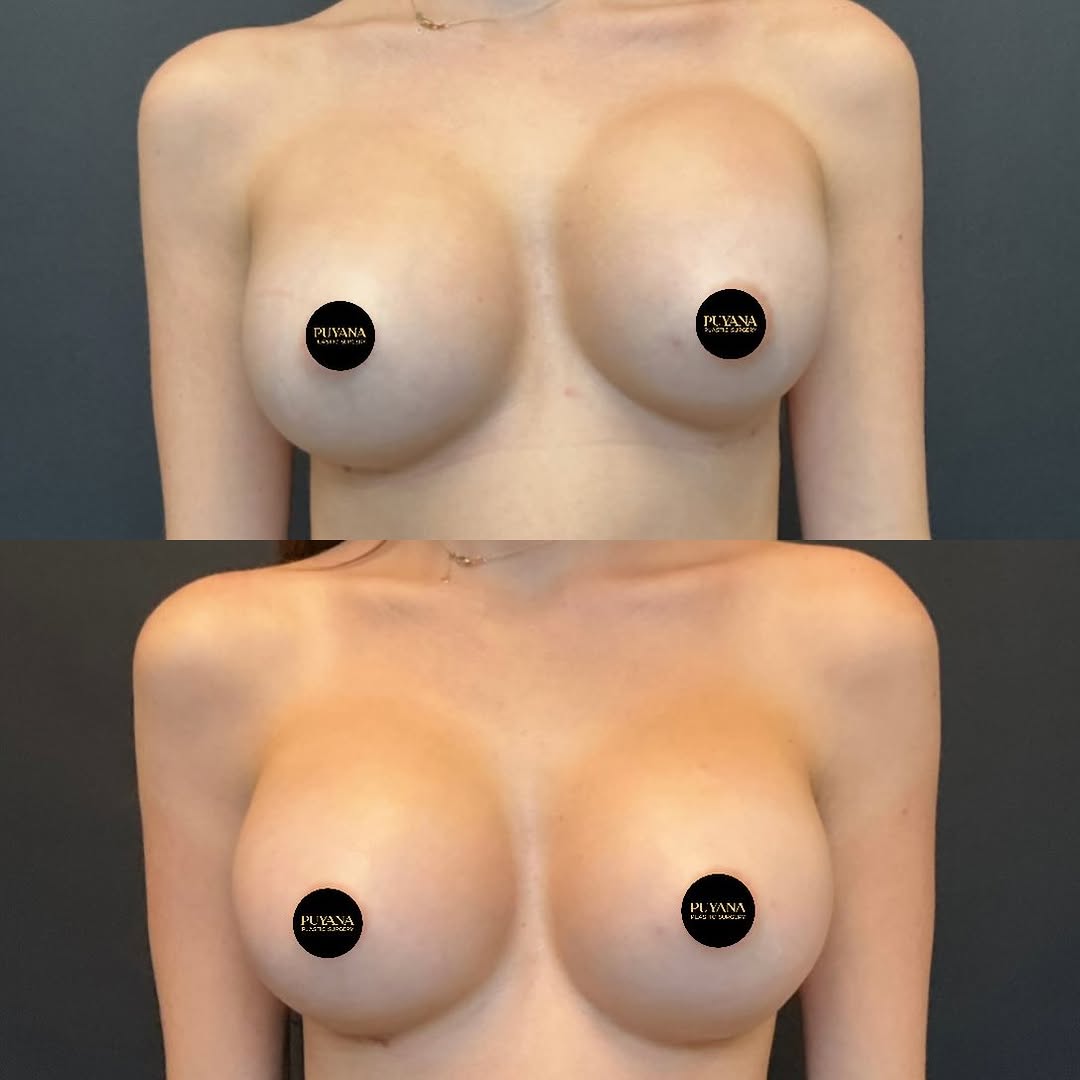 Instagram post by Dr. Salomon Puyana: ✨BREAST IMPLANT EXCHANGE | BEFORE & AFTER✨ En este caso, no se trataba simplemente de cambiar el tamaño de los implantes. Realizamos una cir…