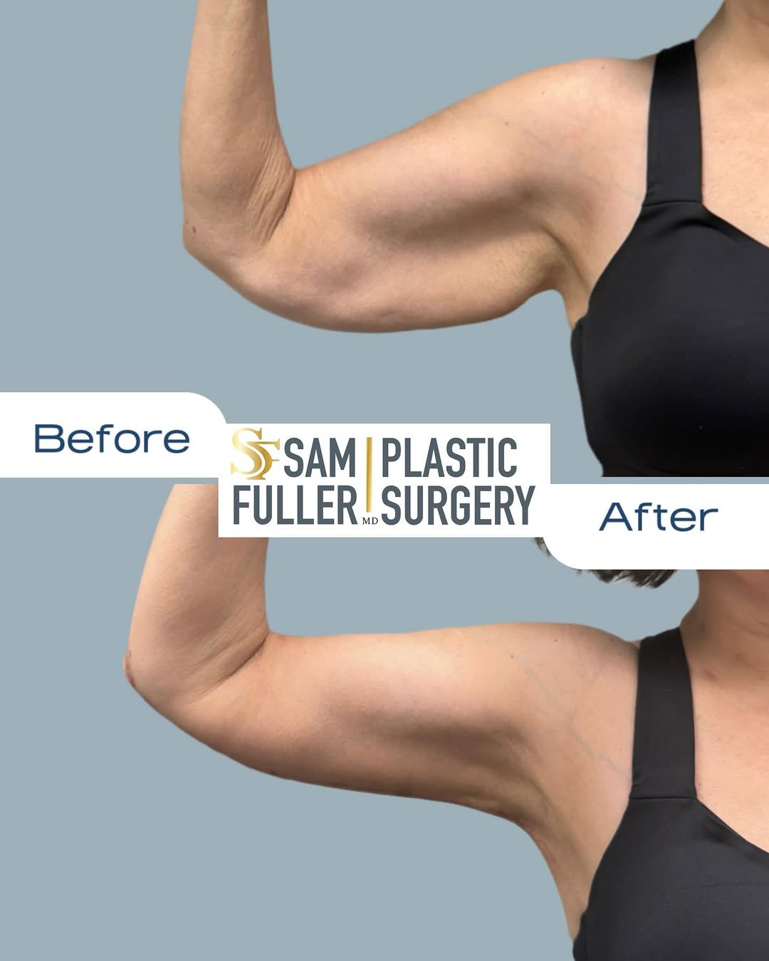 Instagram post by Dr. Sam Fuller: ✨ Three months post-brachioplasty and these arms are serving 🤌! ✨ These arm lift results are already looking snatched — and we’re only at t…