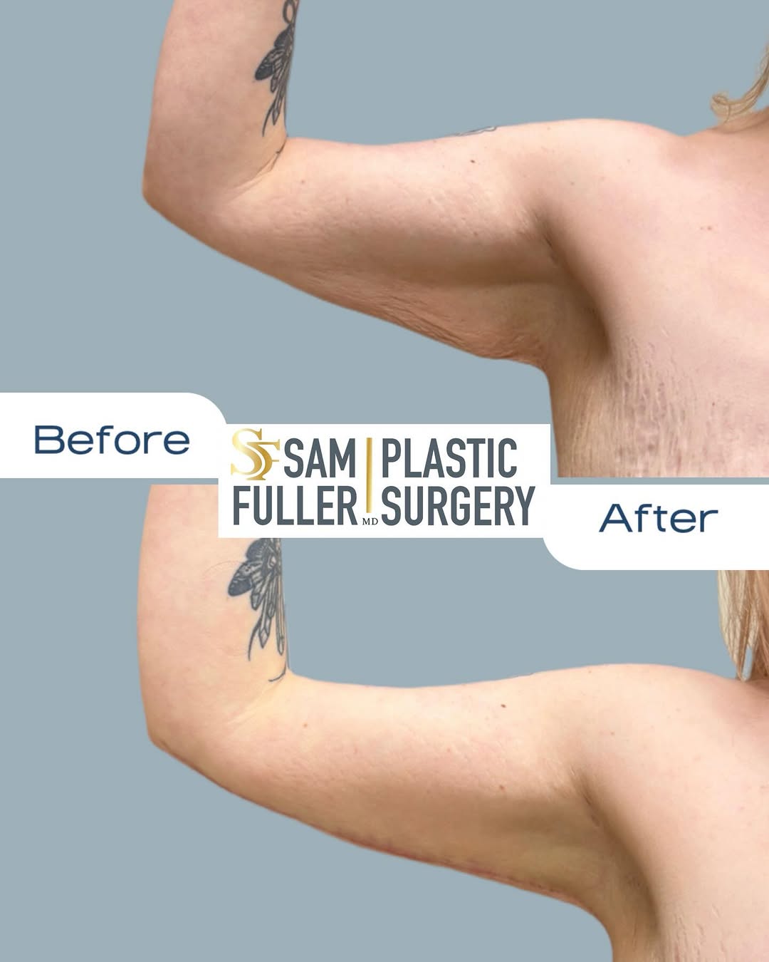 Instagram post by Dr. Sam Fuller: Top 5 Brachioplasty FAQs 1. Who is the best candidate for an arm lift? Patients who have loose, hanging skin of the upper arms—often after s…