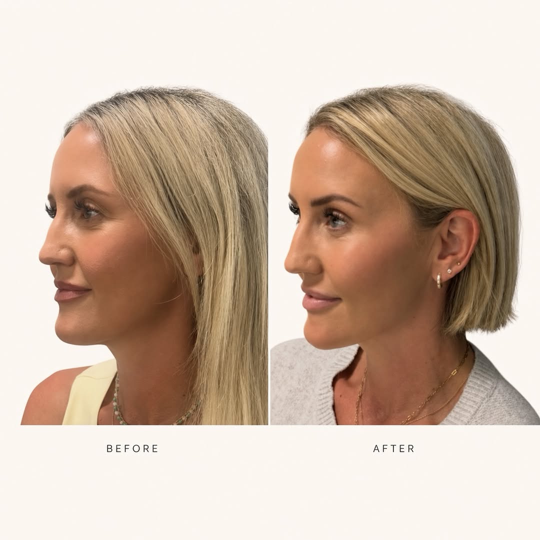 Instagram post by Dr. Sam Jejurikar: A syringe is not a treatment plan. A chin affects the profile. The profile affects the jawline. The jawline affects how the lower face carri…