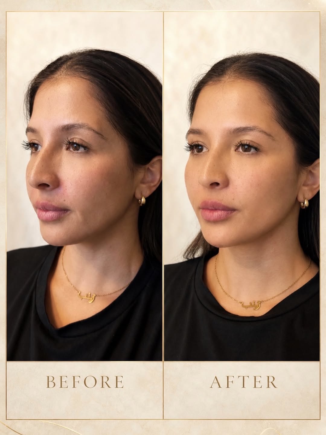 Instagram post by Dr. Sam Jejurikar: A beautiful result does not have to mean a dramatic transformation. For this patient, we focused on intentional, natural facial balancing-re…