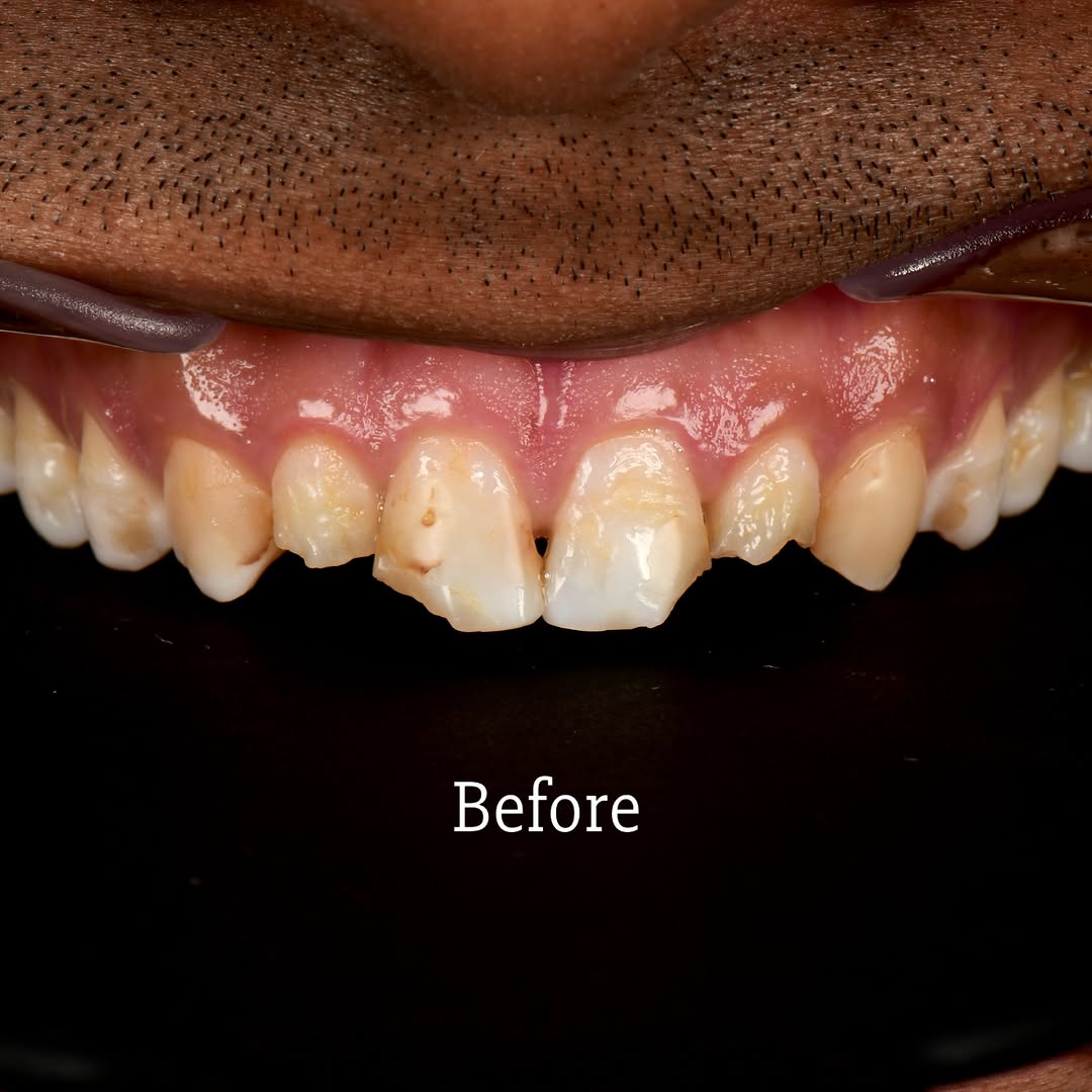 Instagram post by Dr. Sam Saleh: This case is really about function first - and what happens when compromised enamel is combined with an unhealthy bite. The teeth were conge…