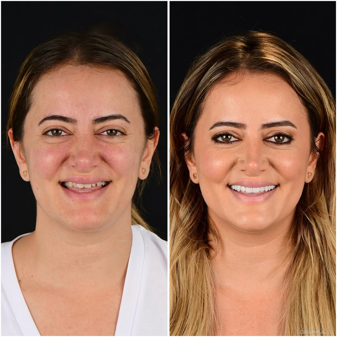 Instagram post by Dr. Sam Saleh: Some smile transformations go far beyond the smile. For years, she hid her teeth in photos and covered her mouth when she laughed. Today, sh…