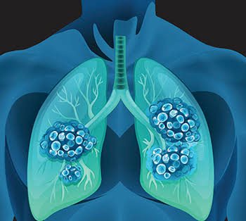 Instagram post by Dr. Sam Speron: The impossible may be becoming possible in the fight against advanced lung cancer! A landmark study found that carefully selected patients w…