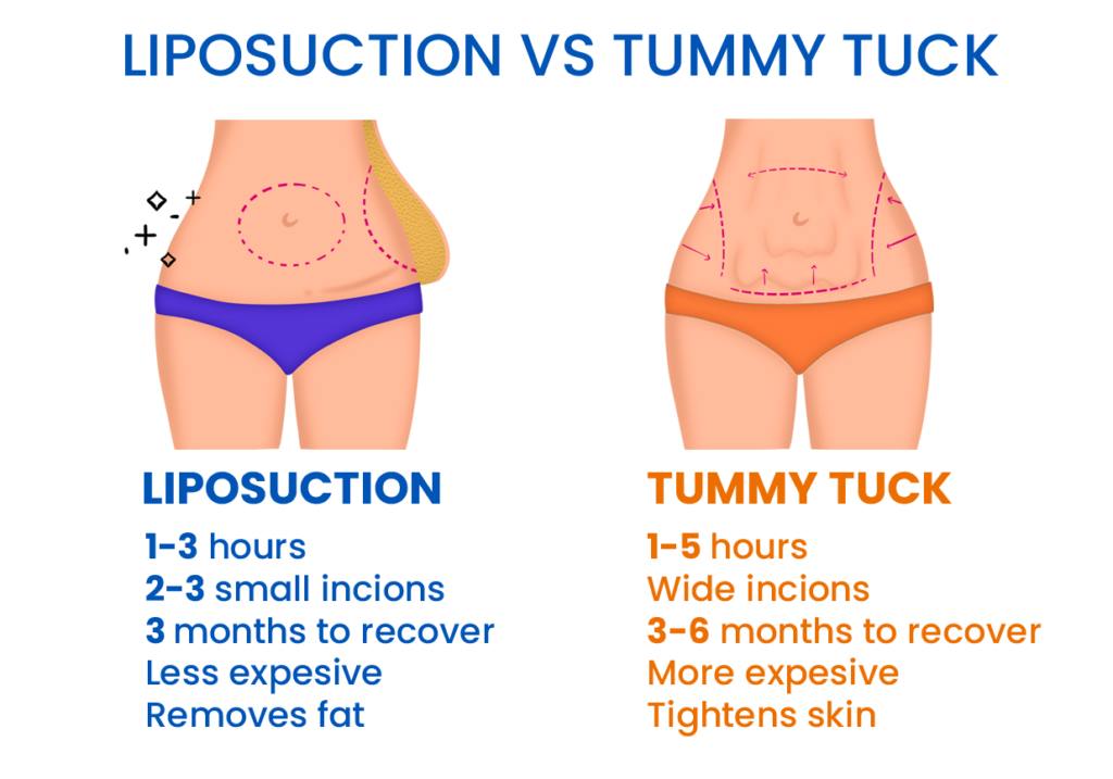 Instagram post by Dr. Sam Speron: This is one of the most common cosmetic surgery misunderstandings. Liposuction focuses on removing localized areas of unwanted fat and impro…