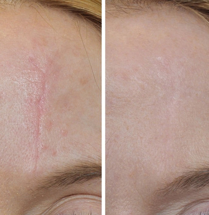Instagram post by Dr. Sam Speron: Scars can develop after surgery, injuries, burns, acne, or other trauma, and no two scars behave exactly the same way. Some may become raise…