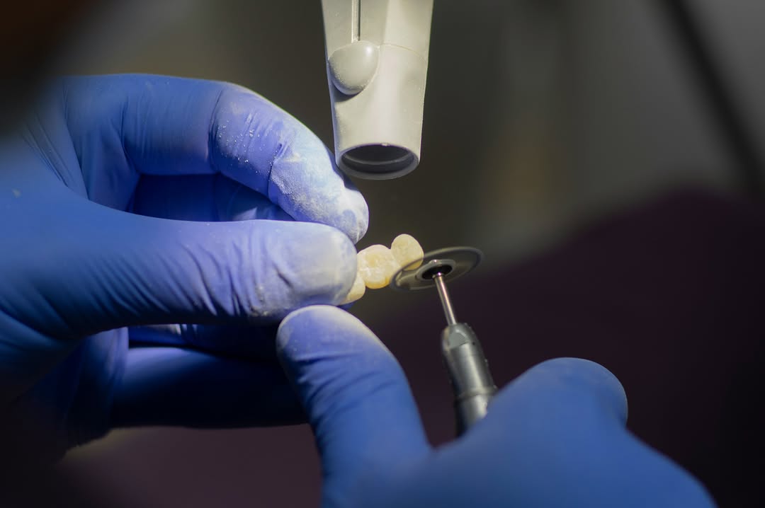 Instagram post by Dr. Sambhav Jain: One team. One location. One seamless smile transformation. Our in-house lab allows our doctors and lab team to work side by side, giving you…