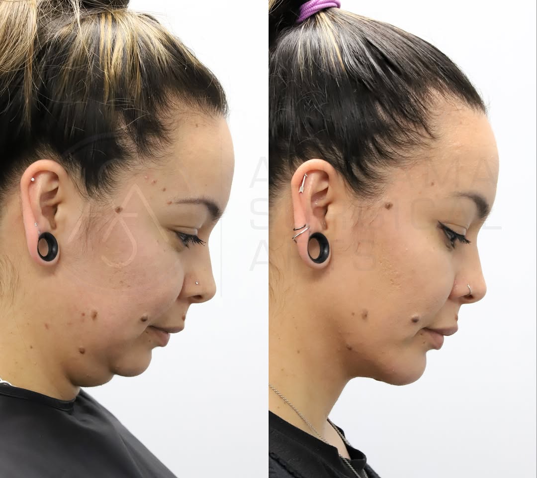 Instagram post by Dr. Sami Nizam II: Procedures performed: Isolated deep neck lift with submandibular gland reduction, buccal fat pad reduction, chin implant Age: 38 Photos take…
