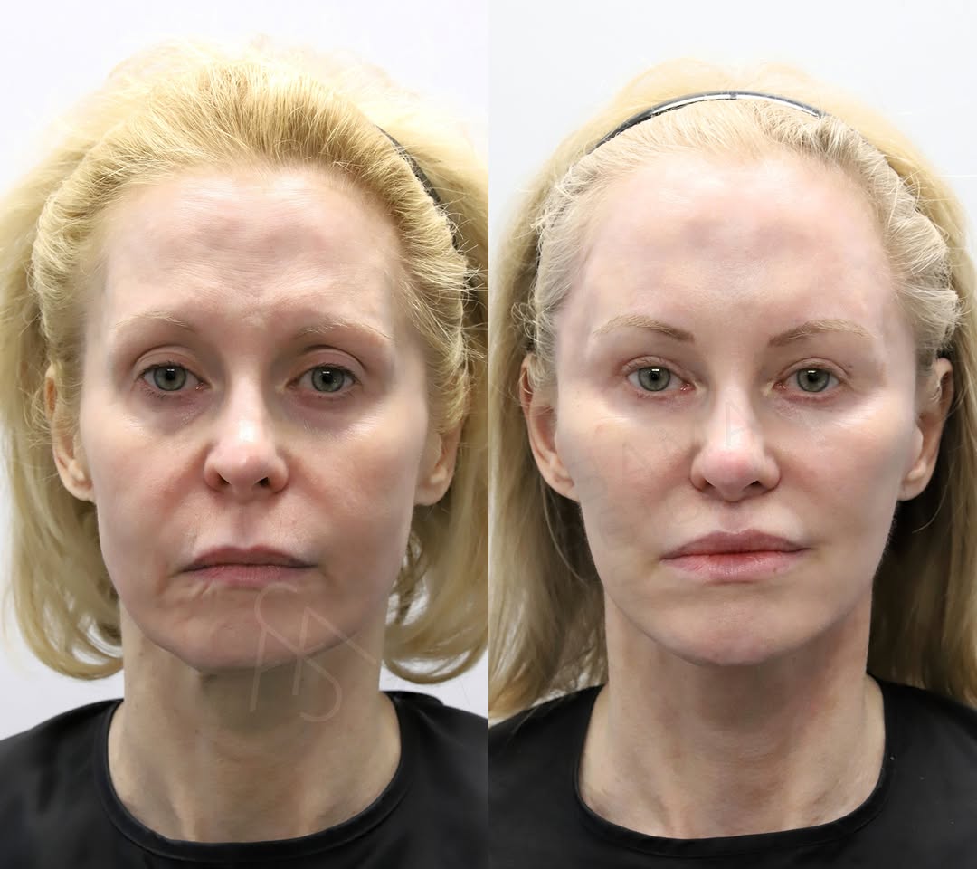 Instagram post by Dr. Sami Nizam II: Procedures performed: Deep plane minilift/endoscopic browlift/ptosis repair/upper blepharoplasty/fat tranfer x 3/laser resurfacing x 3/lip l…
