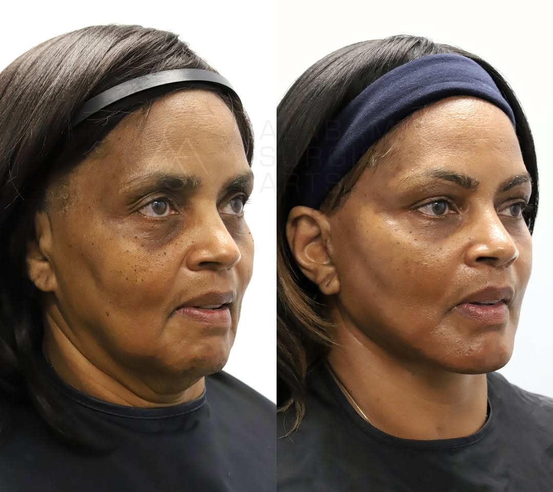 Instagram post by Dr. Sami Nizam II: Procedures performed: Deep plane lower face and neck lift with submandibular gland reduction/stock chin implant/fat transfer/upper blepharop…
