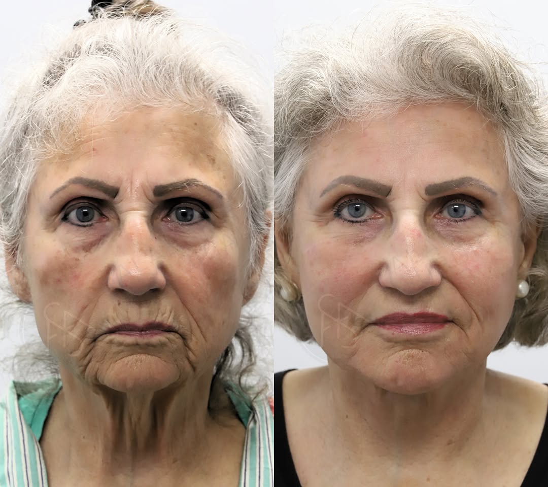 Instagram post by Dr. Sami Nizam II: Procedures performed: Preservation deep plane lower face and neck lift with submandibular gland reduction, fat transfer, nanofat, lip lift, …