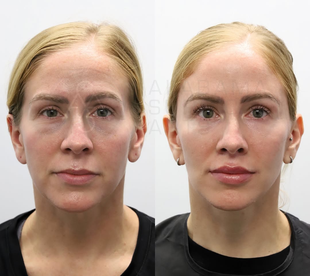 Instagram post by Dr. Sami Nizam II: ****Click More For Cost**** Procedures performed: Deep plane minilift, endsocpic tail of brow lift, eyelid ptosis repair, temple implants, l…