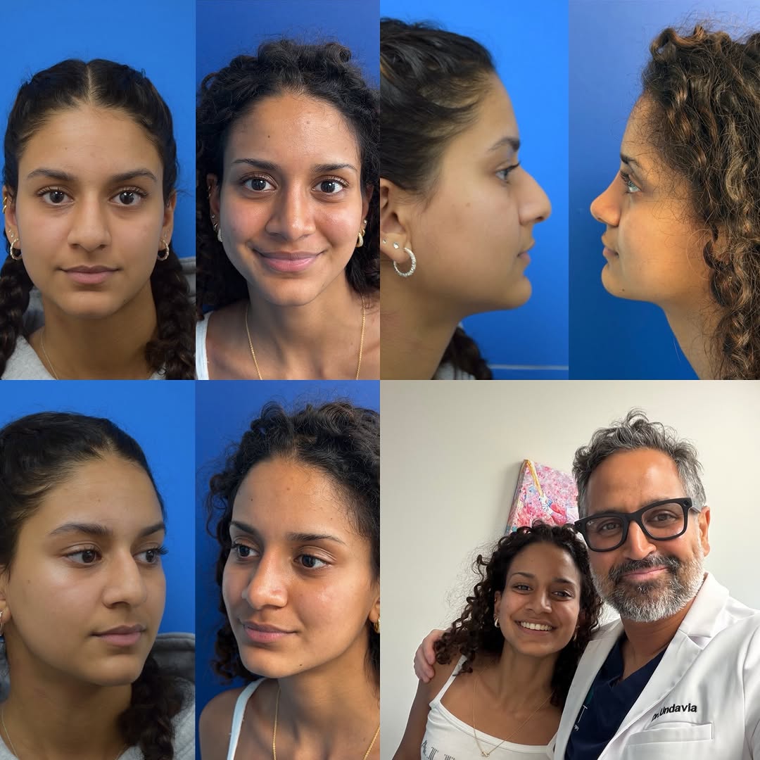 Instagram post by Dr. Samir Undavia: 🤌🏽 - 1 year post rhinoplasty and she looks perfect ❤️#inosenoses #wenosenoses