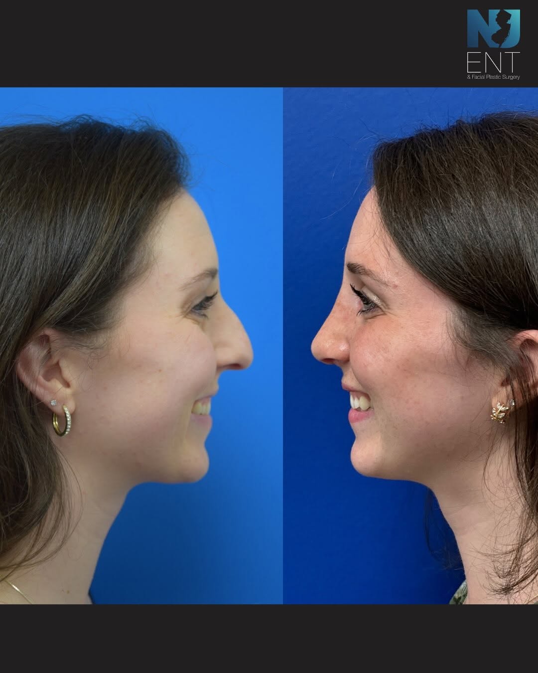 Instagram post by Dr. Samir Undavia: Removing the dorsal hump on our patient’s nose was her main concern. She couldn’t be happier with the result! Schedule your consultation wit…