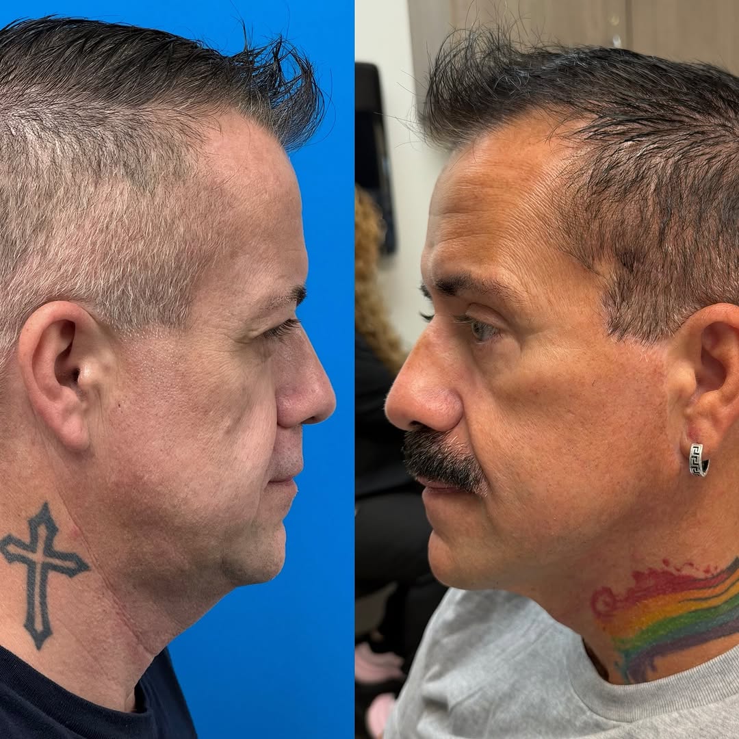 Instagram post by Dr. Samir Undavia: Yup … the same person! Obsessed! Deep plane facelift, browlift , and upper and lower blepharoplasty. He is so incredibly refreshed and hands…