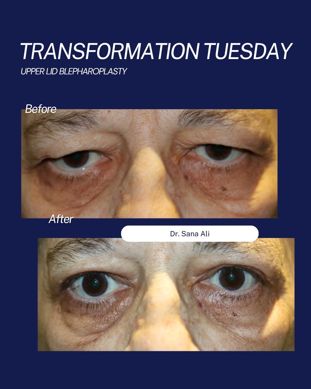 Instagram post by Dr. Samuel Baharestani: ✨ Transformation Tuesday ✨ A subtle change can make a remarkable difference. This week, we're featuring a patient of Sana Ali Bautista, MD w…