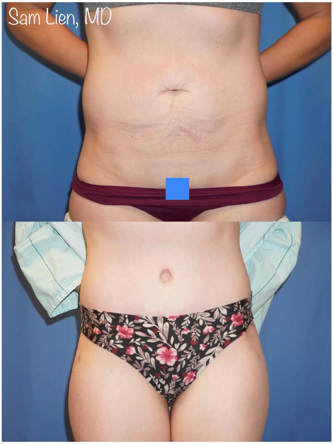 Instagram post by Dr. Samuel Lien: Confidence restored, one step at a time. ✨ This incredible patient came to Dr. Samuel Lien feeling self-conscious about excess abdominal ski…