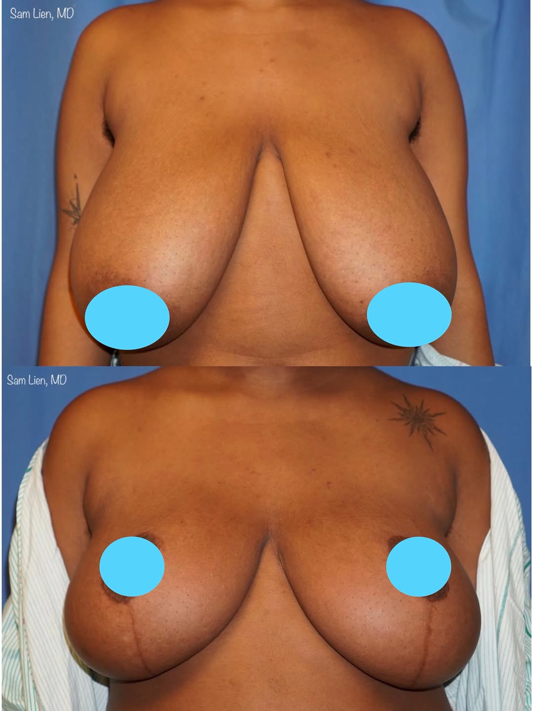 Instagram post by Dr. Samuel Lien: This wonderful young woman came to see me complaining of all the classic symptoms patients have when they have large, heavy breasts: back pa…