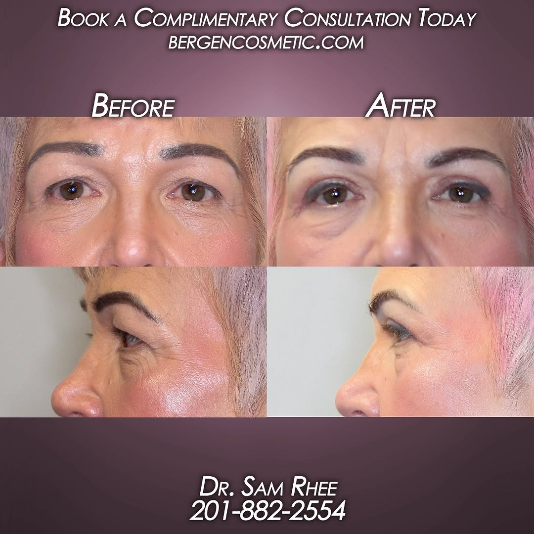 Instagram post by Dr. Samuel Rhee: THREE WEEK POSTOP! - Wonderful patient who underwent an upper blepharoplasty (eyelid lift) resulting in a more youthful eye appearance which…