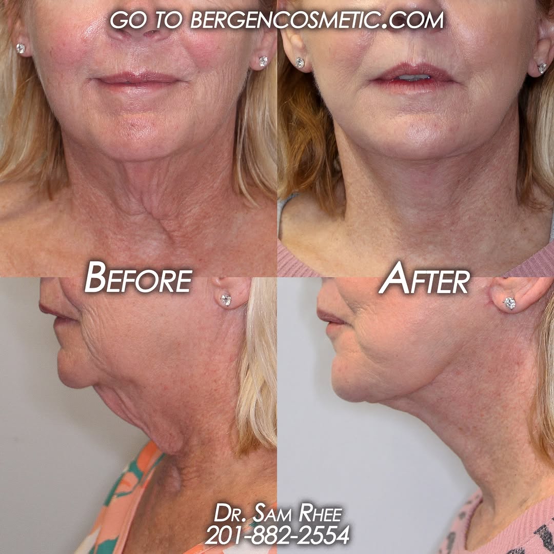Instagram post by Dr. Samuel Rhee: #thankfulthursday wonderful patient who underwent a necklift after 8 weeks. Chiseled and defined! no filters needed --- 20 years of experi…