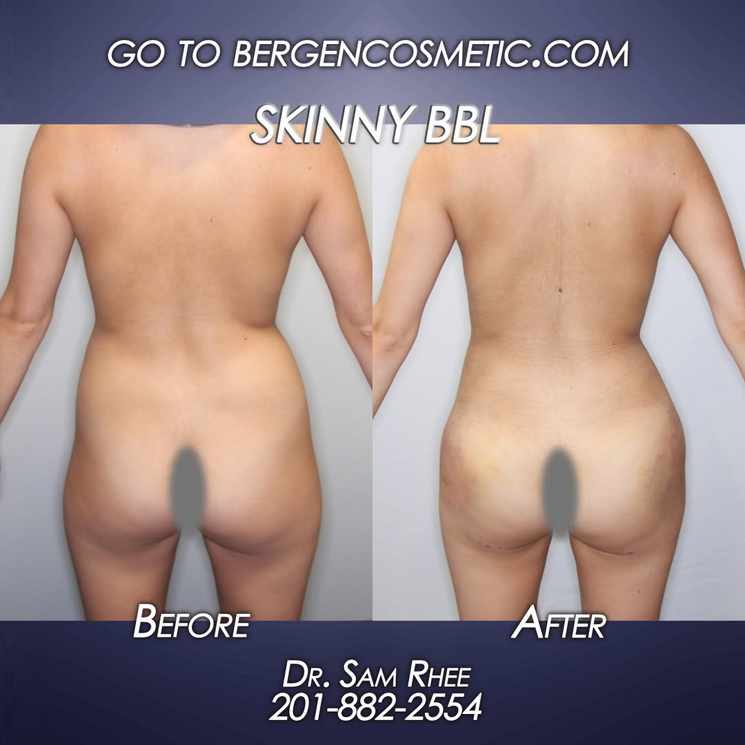 Instagram post by Dr. Samuel Rhee: Real patients. Real results. SKINNY BBL Before and after liposuction and gluteal fat transfer (Brazilian Butt Lift or BBL) - see more before…