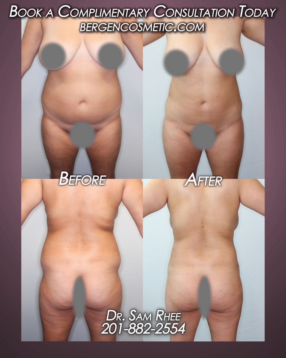 Instagram post by Dr. Samuel Rhee: REAL PATIENTS REAL RESULTS 8 weeks LIPO 360 and HIP DIP FAT TRANSFER Before and after liposuction 360 and hip dip fat transfer (Brazilian Bu…