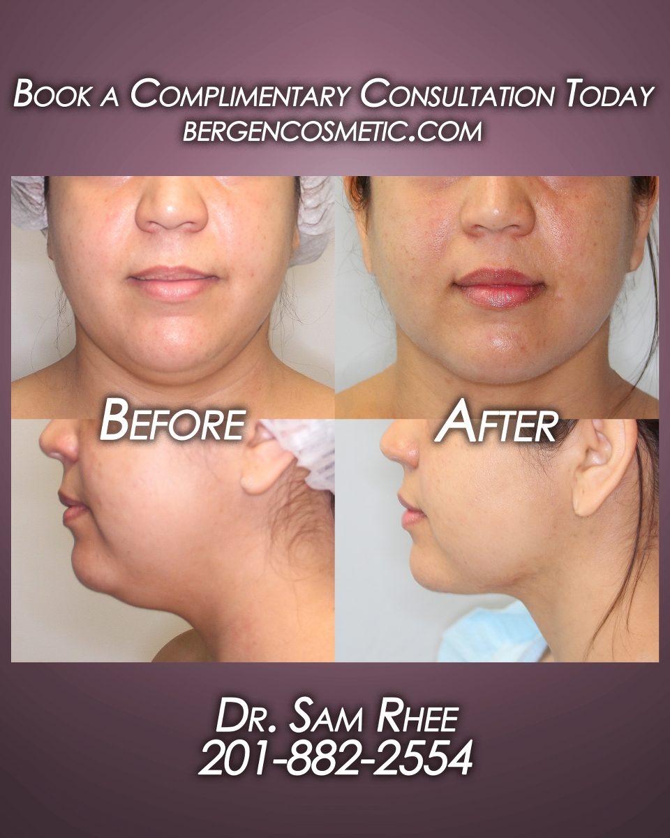 Instagram post by Dr. Samuel Rhee: 1 hour procedure - wonderful patient who underwent neck liposuction after 3 weeks. Youthful and defined! --- One of the most gratifying thi…