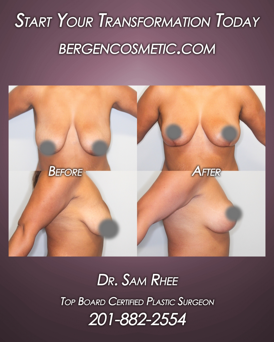 Instagram post by Dr. Samuel Rhee: Before and after Breast Lift (mastopexy) - #MondayMakeover 𝐁𝐞𝐟𝐨𝐫𝐞 & 𝐀𝐟𝐭𝐞𝐫 post - Start Your Transformation Today --- Unfortunate…