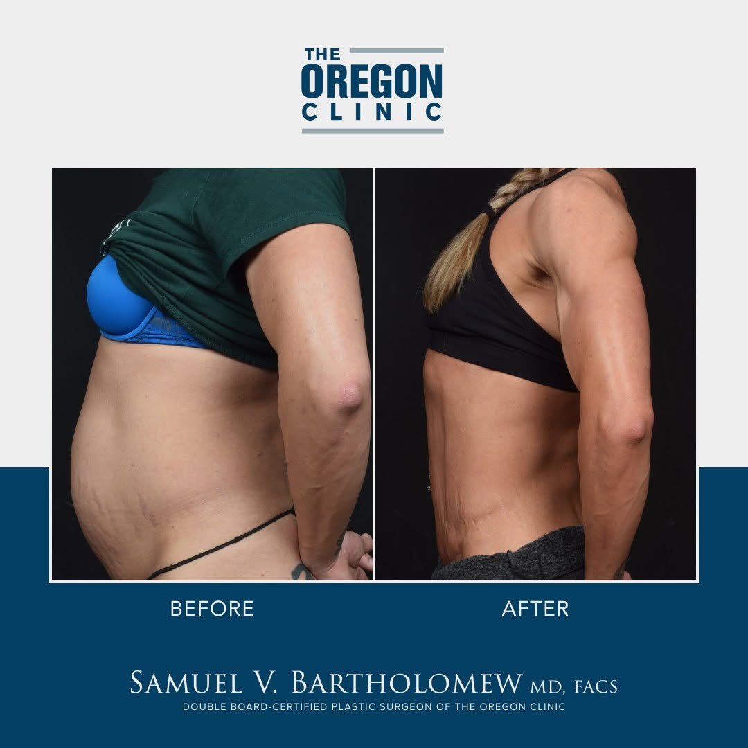 Instagram post by Dr. Samuel V. Bartholomew: Check out these amazing results! My patient is a mother of 2 and has a history of a hysterectomy with large epigastric hernia and rectus dia…
