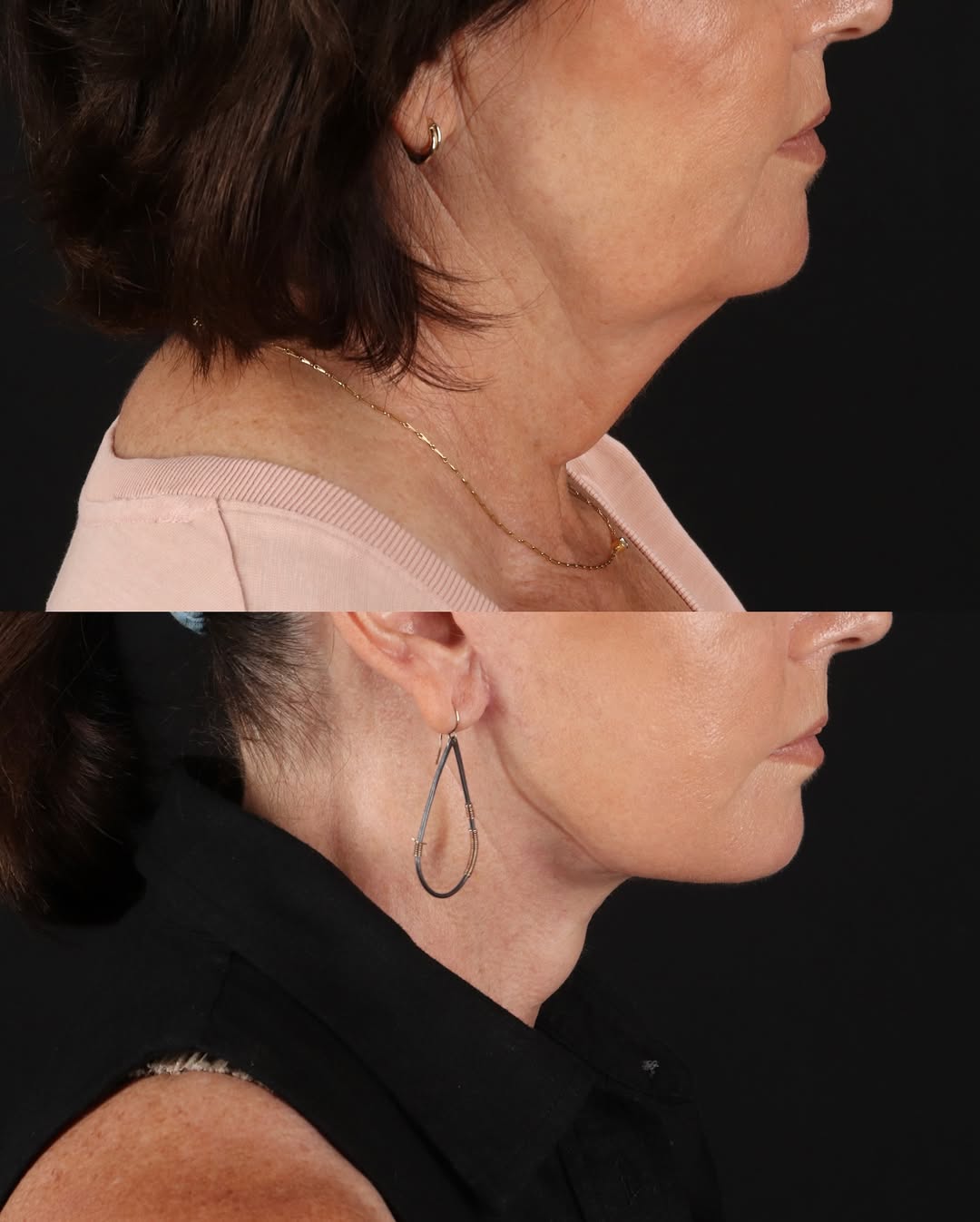 Instagram post by Dr. Sanaz Harirchian: 1 year, 2 months after Deep Plane Facelift + Necklift π€© This is what deep structural neck recontouring actually looks like. All layers of tβ¦